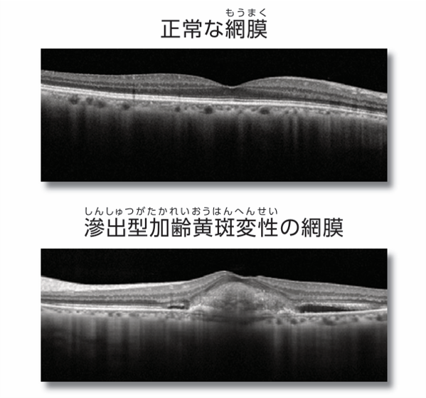 光干渉断層計 （Optical Coherence Tomography：OCT）