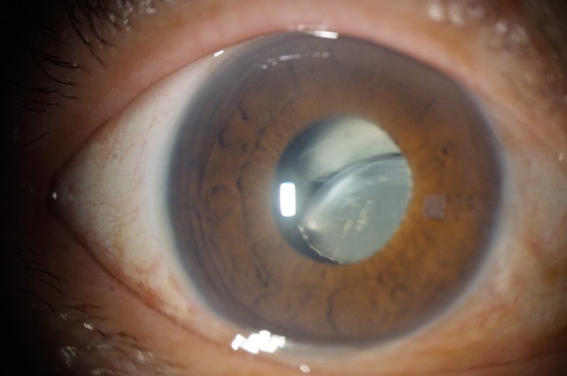 眼内レンズ亜脱臼
