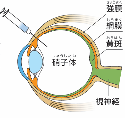 抗VEGF薬硝子体注射とは