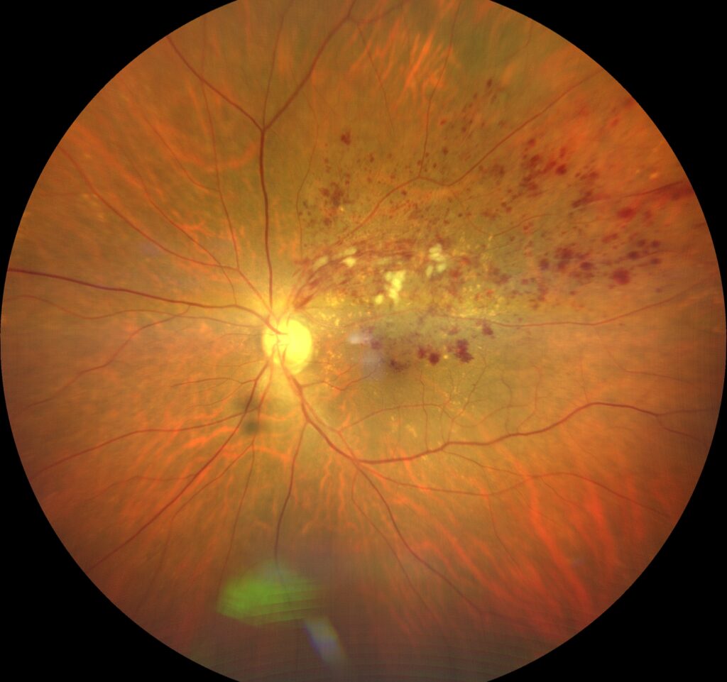 網膜血管閉塞症